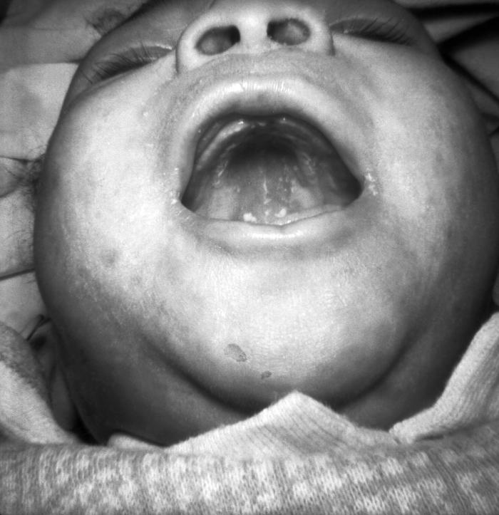 A photograph of a young child with congenital syphilis exhibiting intraoral mucous patches and facial skin lesions. An infant demonstrating mucous patches and skin lesions resulting from congenital syphilis. In 1998, 81.3% of reported cases of CS occurred because the mother received no penicillin treatment or inadequate treatment before or during pregnancy. Adapted from CDC
