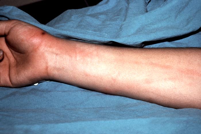 This patient presented with a lesion of the right hand due to a disseminated Neisseria gonorrhoeae bacteremia. Though a sexually transmitted disease, if a Gonorrhea infection is allowed to go untreated, the Neisseria gonorrhea bacteria responsible for the infection can become disseminated throughout the body, forming lesions in extra-genital locations. Adapted from CDC