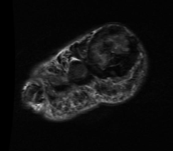 File:Gout MRI 002.jpg
