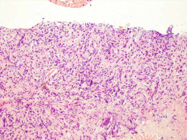 A kidney biopsy showing effacement of the renal structure by diffuse leukocytic infiltrate, represented mostly by elongated cells with marked artifactual changes.<ref name = casereport>Angioimmunoblastic T-cell lymphoma presenting as giant kidneys: a case report