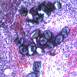 Eggs of A. lumbricoides in an appendix biopsy, stained with H&E. This image was taken at 200x magnification. Adapted from CDC