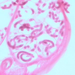 Microfilariae of O. volvulus within the uterus of an adult female. The specimen was taken from the same patient as in Figure A. Image taken at 500x magnification, oil. Adapted from CDC