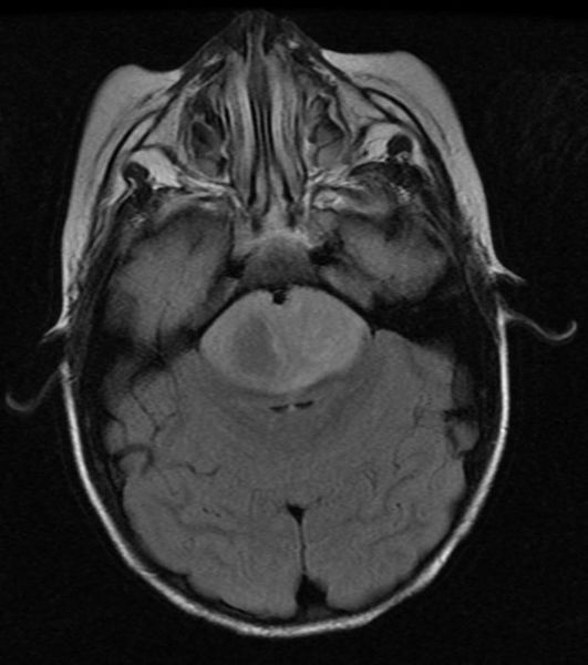 File:Brainstem-glioma-001.jpg
