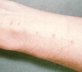 Skin of a patient showing the inflammatory response to cercaria in the skin. Adapted from CDC