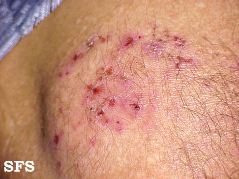 File:Dermatitis herpetiformis04.jpg