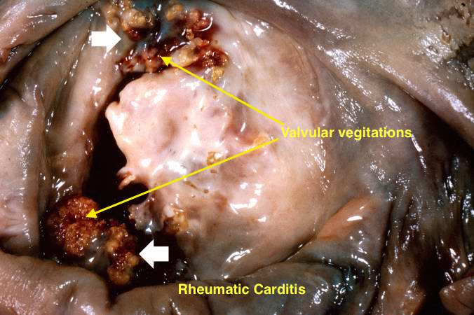 File:Acute Rheumatic Myocarditis-1.jpg