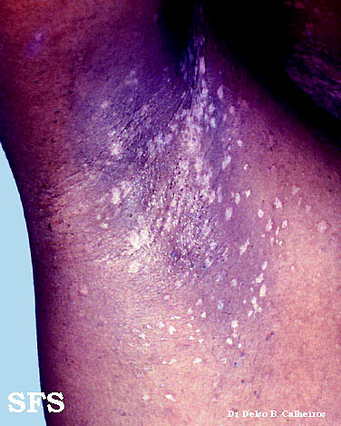 Epidermodysplasia verruciformis. Adapted from Dermatology Atlas.[2]