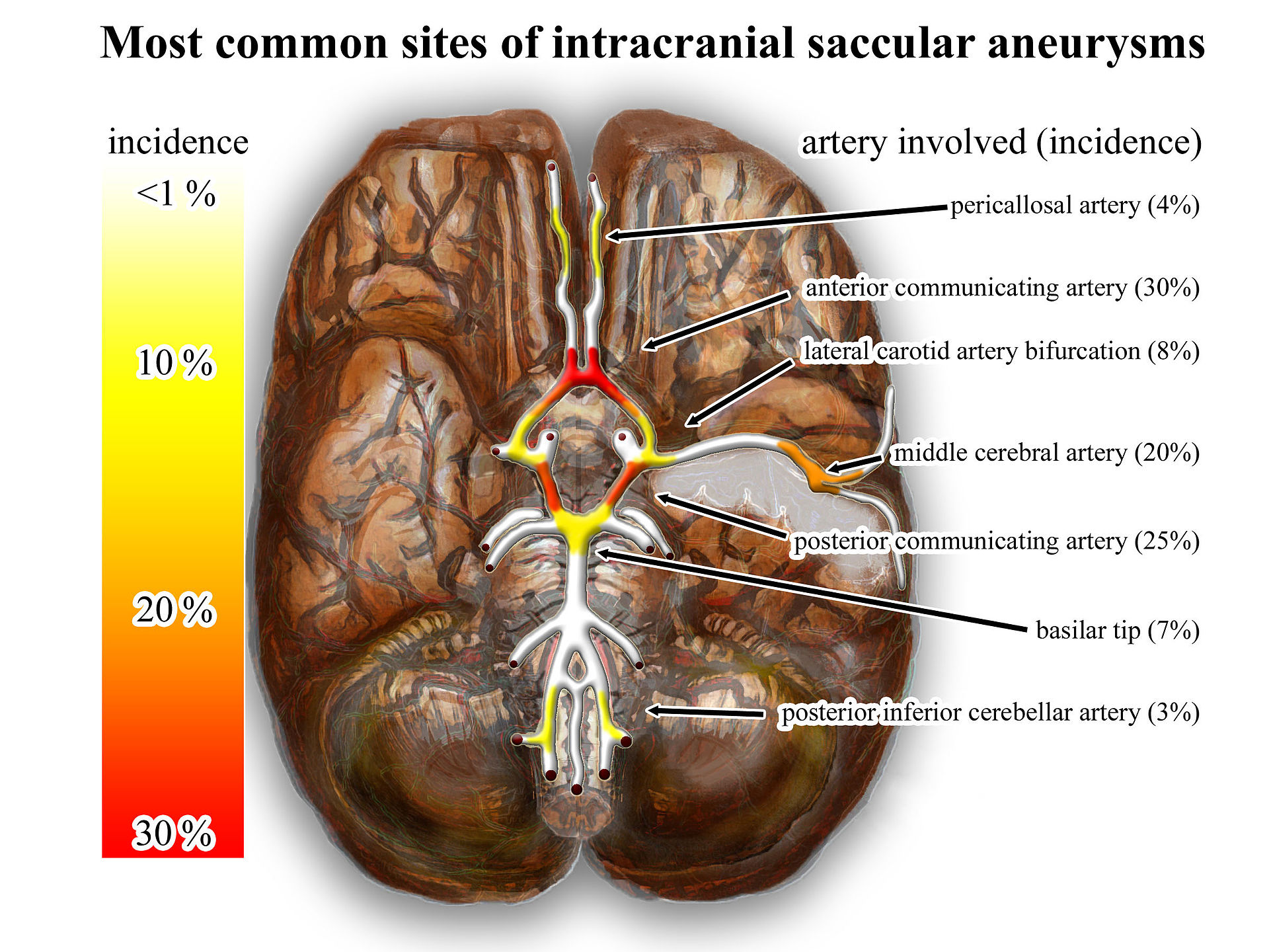 File:Wikipedia intracranial aneurysms - inferior view - heat map.jpg