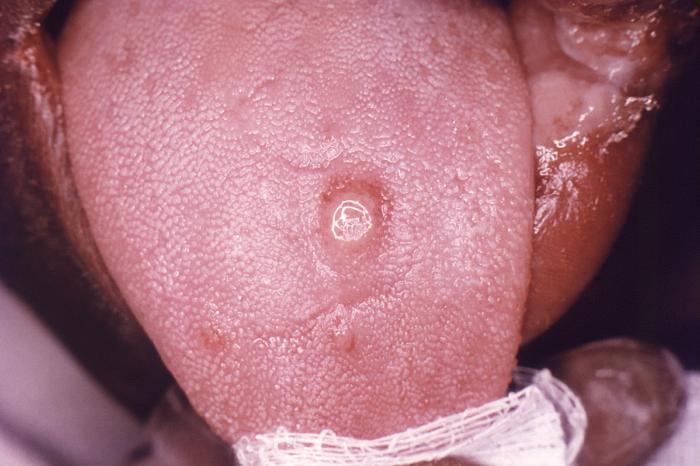 This image depicts a close view of the surface of an African-American female’s tongue, upon which one can see a circular lesion that was diagnosed as a primary syphilitic chancre. The primary stage of syphilis is usually marked by the appearance of a single sore (called a chancre), but there may be multiple sores. The time between infection with syphilis and the start of the first symptom can range from 10 to 90 days (average 21 days). The chancre is usually firm, round, small, and painless. It appears at the spot where syphilis entered the body. The chancre lasts 3 to 6 weeks, and it heals without treatment. However, if adequate treatment is not administered, the infection progresses to the secondary stage. Adapted from CDC