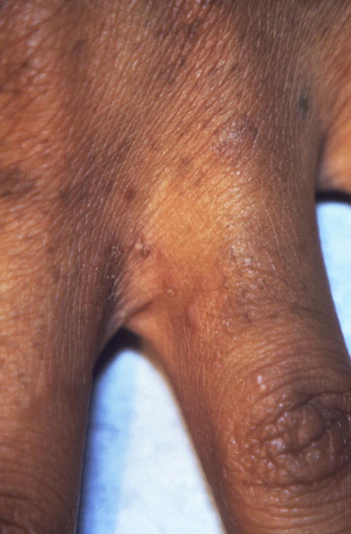 This photograph depicting the dorsal surface of a human hand focused on the interdigital web space between the index and middle fingers, and revealed the presence of papules due to an infestation of the human itch mite, Sarcoptes scabiei var. hominis, otherwise commonly known as scabies. The most common signs and symptoms of scabies are intense itching (pruritus), especially at night, and a pimple-like (papular) itchy rash. The itching and rash each may affect much of the body or be limited to common sites such as the wrist, elbow, armpit, webbing between the fingers, nipple, penis, waist, belt-line, and buttocks. The rash also can include tiny blisters (vesicles) and scales. Scratching the rash can cause skin sores; sometimes these sores become infected by bacteria. Adapted from CDC