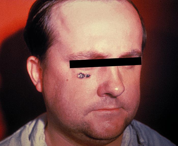 "Anthrax skin lesion on face of man. Cutaneous”Adapted from Public Health Image Library (PHIL), Centers for Disease Control and Prevention.[3]