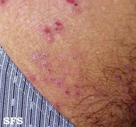File:Dermatitis herpetiformis01.jpg
