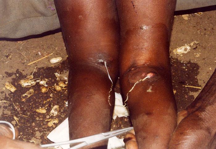 This image depicts the subcutaneous emergence of two female Guinea worms, Dracunculus medinensis, from the popliteal region of both of a sufferer’s legs, i.e., behind both knees. From Public Health Image Library (PHIL). [8]