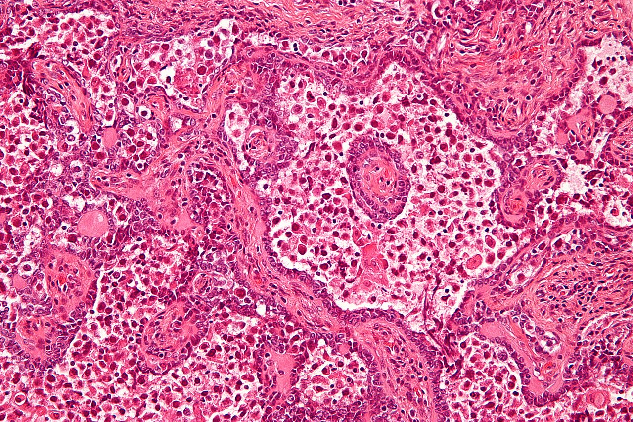 File:1280px-Gonadoblastoma - high mag.jpg