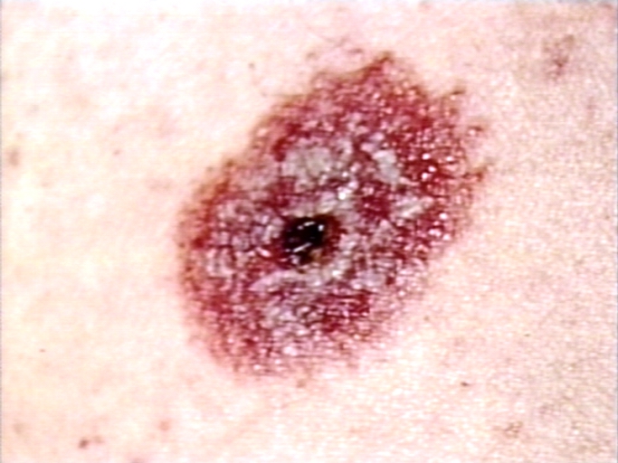 Skin:Leucocytolastic vasculitis; a close up view