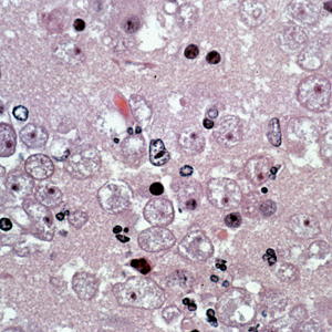 Several trophozoites of B. mandrillaris in brain tissue, stained with hematoxylin and eosin (H&E). Adapted from CDC
