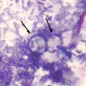 Two oocysts of C. cayetanensis stained with modified acid-fast stain. Both oocysts failed to take up the carbol fuschin stain. Image courtesy of the Arizona State Public Health Laboratory. Adapted from CDC