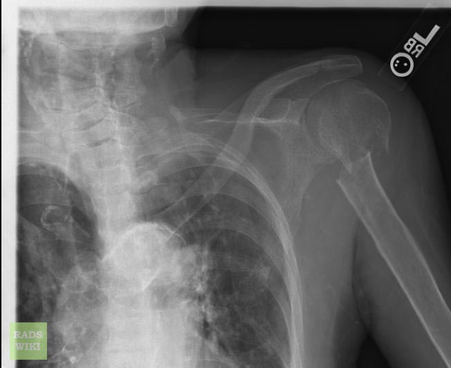 File:Humeral-neck-fracture-001.jpg