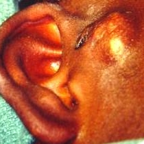 An infected preauricular cyst that had been incised and drained. In order to excise this cyst, it was allowed to "refill" prior to definitive surgery.[3]