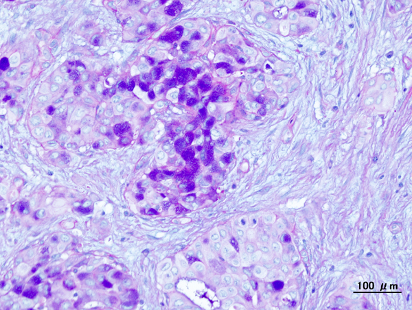 Histopathologic image of mucoepidermoid carcinoma. Postoperative recurrence of the submandibular tumor. Alcian blue-PAS stain.[17]