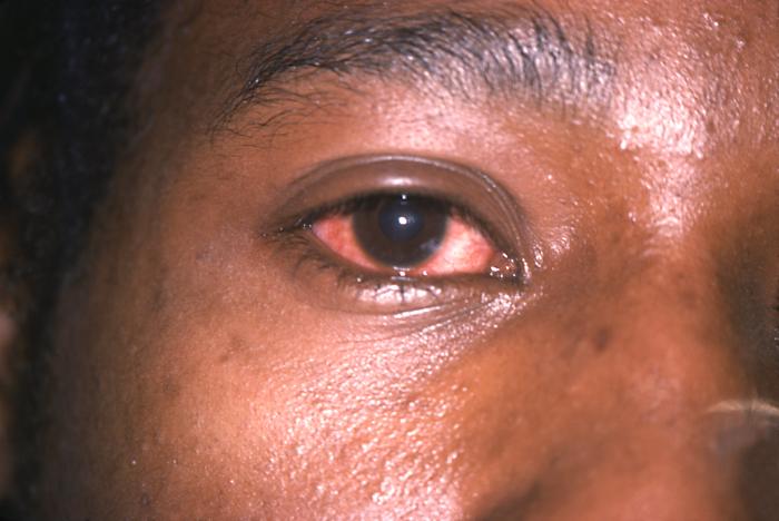 This patient with diagnosed gonococcal urethritis presented with unilateral gonococcal conjunctivitis. See PHIL 16400, for the appearance of her eye 24 hours following treatment with 4.8 million units of aqueous procaine penicillin G (APPG) and probenicid. If untreated N. gonorrhoeae bacteria may spread to the bloodstream, and thereby, throughout the body. The most common symptoms are then rash and joint pains, but other generalized symptoms may result as well such as conjunctivitis. Adapted from CDC