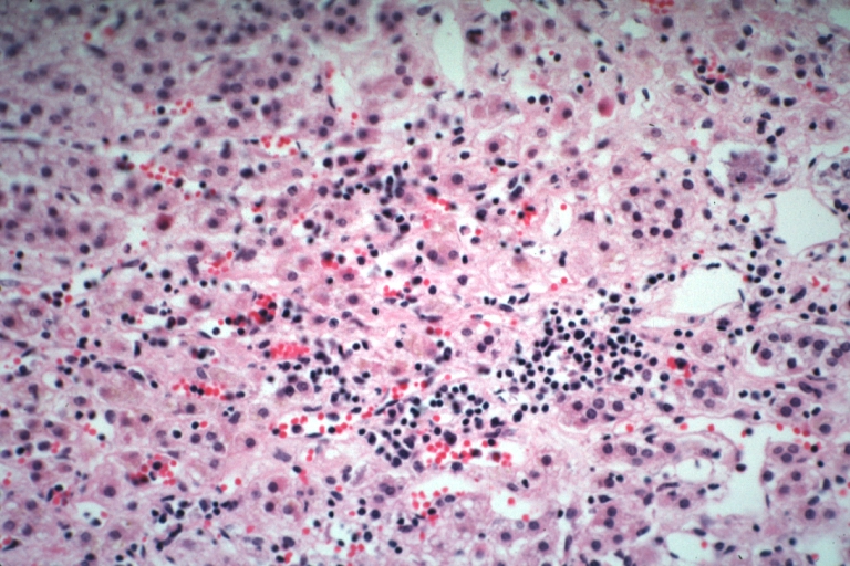 Adrenal: Autoimmune Adrenalitis: Micro high mag H&E focal area of lymphocytic infiltration in zona reticularis in a 19yo female with lupus erythematosus