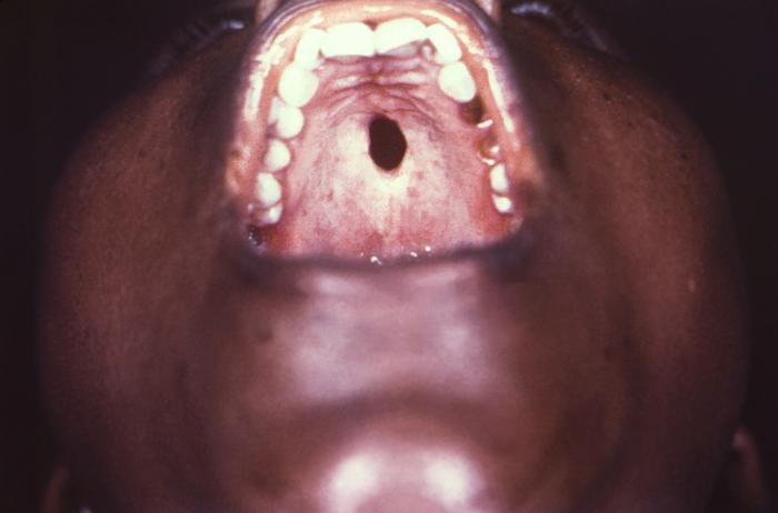 This image depicts an inferior, intraoral view of a patient’s hard palate revealing the pathologic changes in palatal anatomy, which resulted in a perforation into the nasal cavity, and was due to a congenital syphilitic infection. Congenital syphilis, is a condition caused by infection in utero with Treponema pallidum. A wide spectrum of severity exists, and only severe cases are clinically apparent at birth. An infant or child (aged less than 2 years) may have signs such as hepatosplenomegaly, rash, condyloma lata, snuffles, jaundice (nonviral hepatitis), pseudoparalysis, anemia, or edema (nephrotic syndrome and/or malnutrition). An older child may have stigmata (e.g., interstitial keratitis, nerve deafness, anterior bowing of shins, frontal bossing, mulberry molars, Hutchinson teeth, saddle nose, rhagades, or Clutton joints). Adapted from CDC