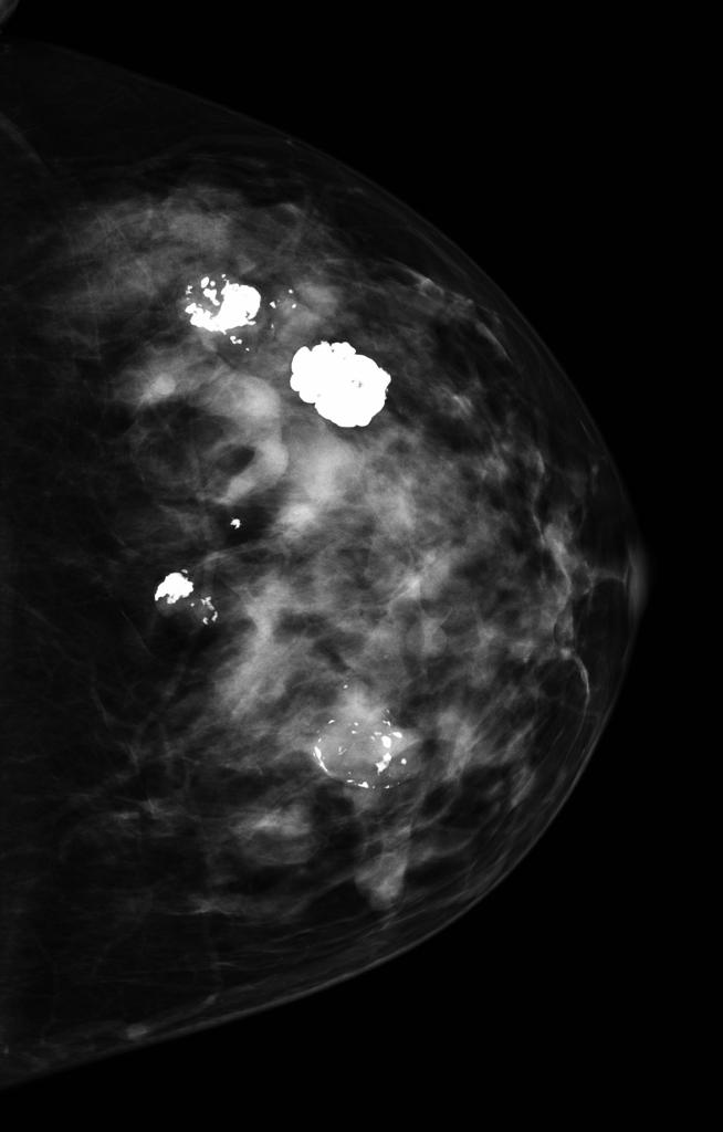 File:Fibroadenoma mammogram 2.jpg