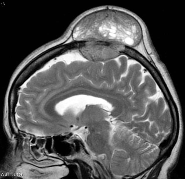 File:Radiopedia MRI brain metastasis - Copy.jpg