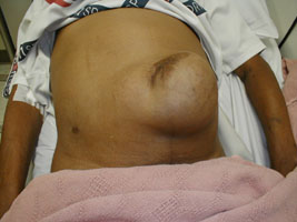 Umbilical hernia during valsalva maneuver