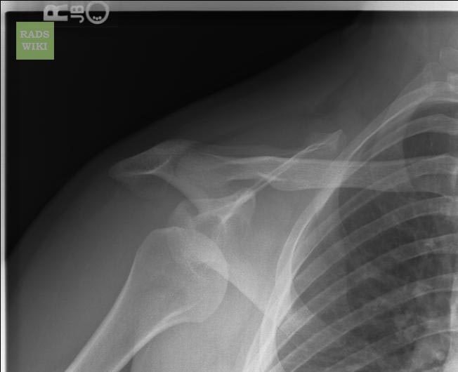 Anterior shoulder dislocation: Dislocation