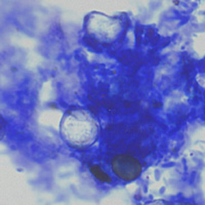 Oocysts of C. cayetanensis stained with modified acid-fast stain. Note the wrinkled edge and the lack of stain in the two oocysts. Image courtesy of the Arizona State Public Health Laboratory. Adapted from CDC