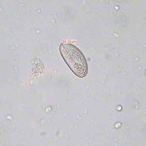 Egg of E. vermicularis teased from an adult worm recovered from a colonoscopy. Image contributed by the South Carolina Department of Health and Environmental Control, Bureau of Laboratories. Adapted from CDC