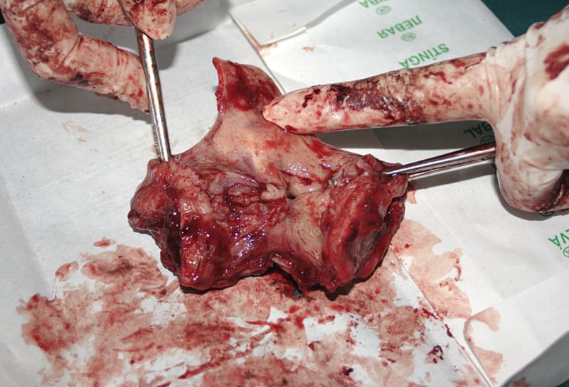 Gross pathology specimen of laryngeal cancer[1]