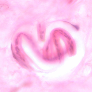 Coiled microfilaria of O. volvulus, in a skin nodule from a patient from Zambia, stained with H&E. Image taken at 1000x oil magnification. Adapted from CDC