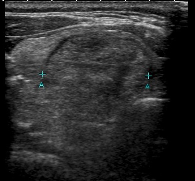 File:Papillary thyroid cancer ultrasound 2.jpeg