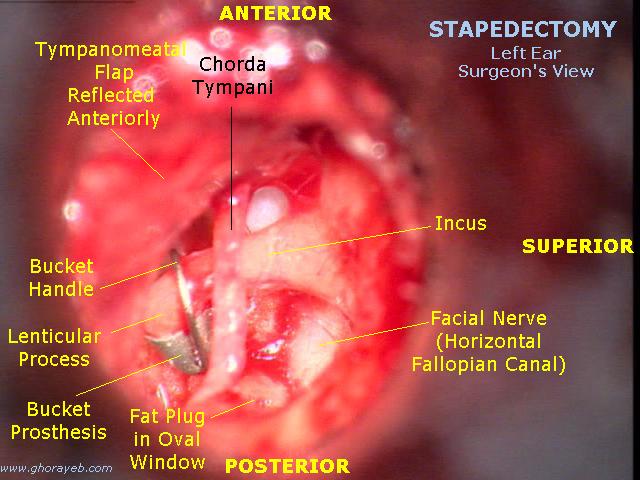 Stapedectomy - wikidoc