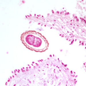 Egg of D. renale in the kidney of a mink, stained with hematoxylin and eosin (H&E). Adapted from CDC