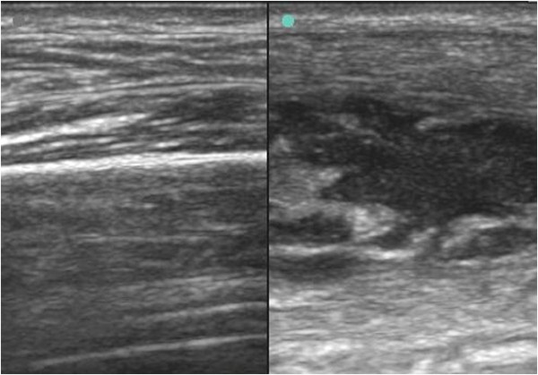Ultrasonography of pyomyositis. Left: Normal quadriceps muscle. Right: Quadriceps intramuscular loculated abscess or pyomyositis.[21]