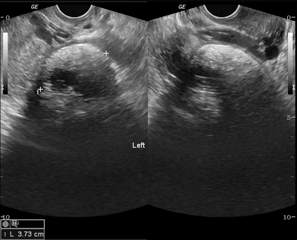 Ovarian dermoid left adnexa[4]