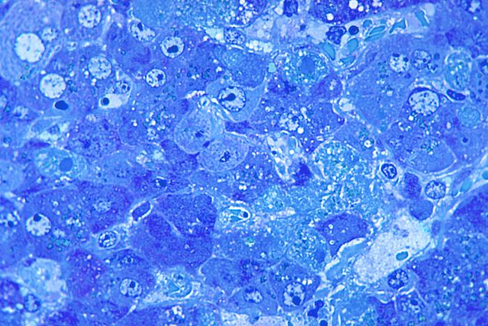 This photomicrograph demonstrates hepatitis caused by the Lassa virus, using toluidine-blue azure II stain. Retrieved from the Public Health Image Library (PHIL) of the Centers for Disease Control and Prevention.Retrieved from the Public Health Image Library (PHIL), Centers for Disease Control and Prevention.[10]