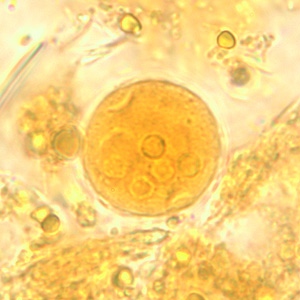 Cyst of E. coli in a concentrated wet mount stained with iodine. Five nuclei are visible in this focal plane. Adapted from CDC