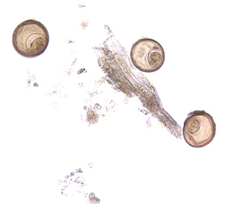 Eggs of H. diminuta in an unstained wet mount of concentrated stool. Image taken at 200x magnification. Adapted from CDC
