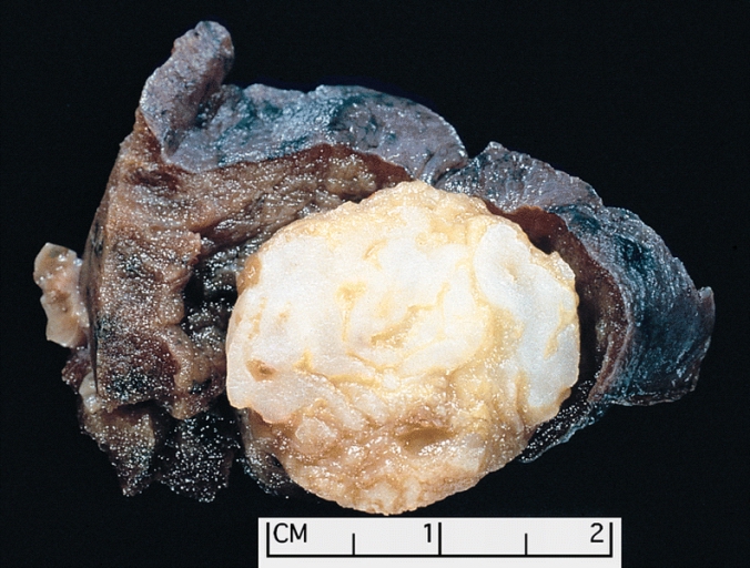 Pulmonary hamartoma: the surrounding lung falls away from the well-circumscribed mass, a typical feature of these lesions. The hamartoma shows a variegated yellow and white appearance, which corresponds respectively to fat and cartilage.[7]