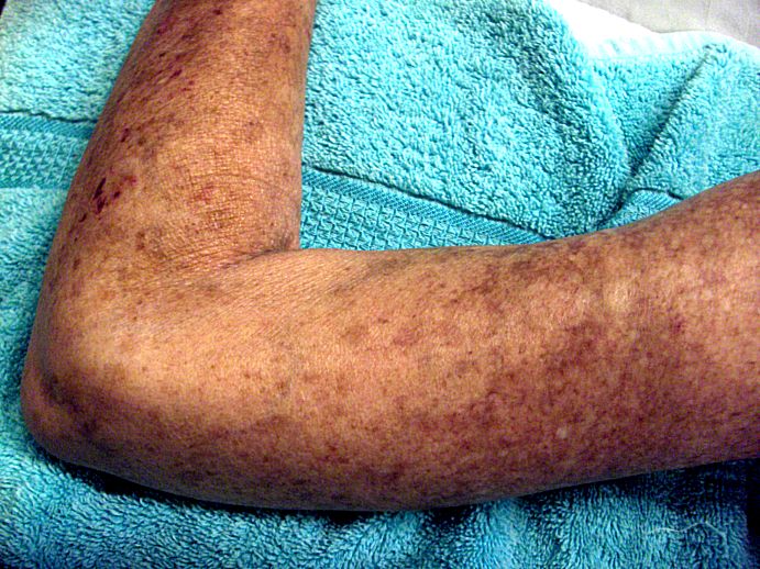 Left arm of Scleroderma patient, showing skin lesions