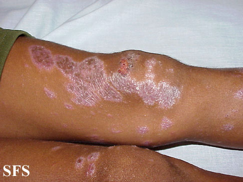 Lichen planus actinicus. Adapted from Dermatology Atlas.[1]