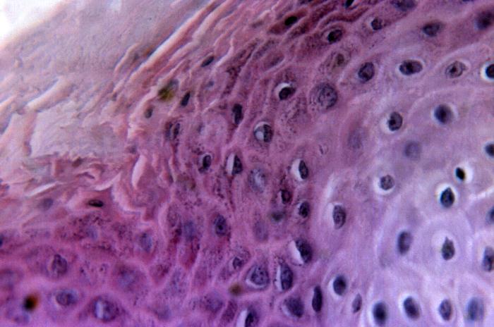 Cytoarchitectural pathologic changes found in a sample of skin tissue from a eczema vaccinatum lesion, which had manifested itself after this patient had received a smallpox vaccination.Adapted from Public Health Image Library (PHIL), Centers for Disease Control and Prevention.[14]