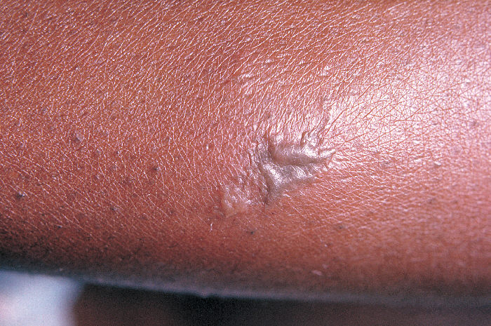 Close-up of a gonococcal lesion on the skin of a patient’s arm. Gonorrhea, caused by Neisseria gonorrhoeae, if left untreated will enter the blood, thereby, spreading throughout the body. As is shown here, such full body dissemination may manifest itself as skin lesions in the form of gray pustules. Adapted from CDC