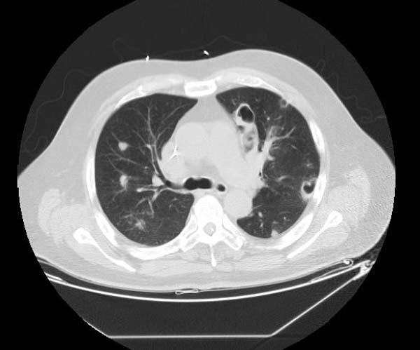 Pulmonary septic emboli
