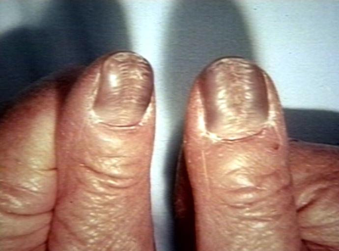 Hydroxyurea Nails; Nail changes associated with Hydroxyurea therapy in a patient with essential thrombocythemia